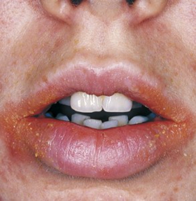 嘴角念珠菌感染图片图片
