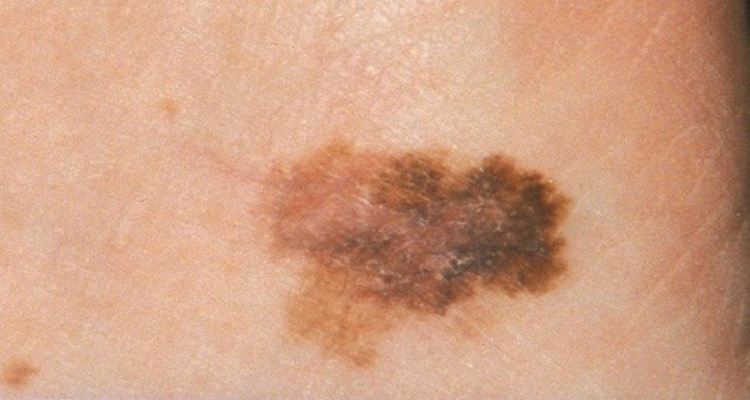 皮肤癌早期症状 (33)