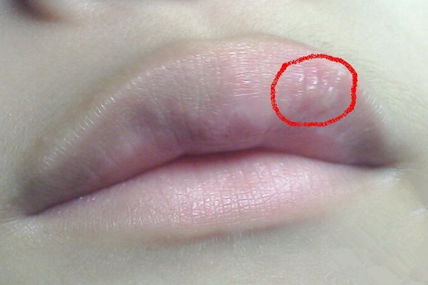 艾滋病的嘴唇疱疹图片图片