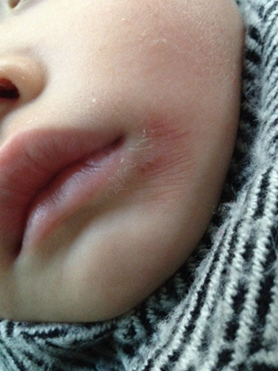 宝宝下嘴唇下面疱疹图图片