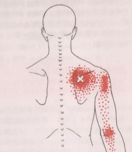 肩胛骨筋膜炎的症状图图片