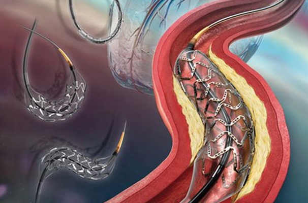 心脏支架手术 (20)