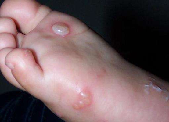 足部疱疹的症状图片图片