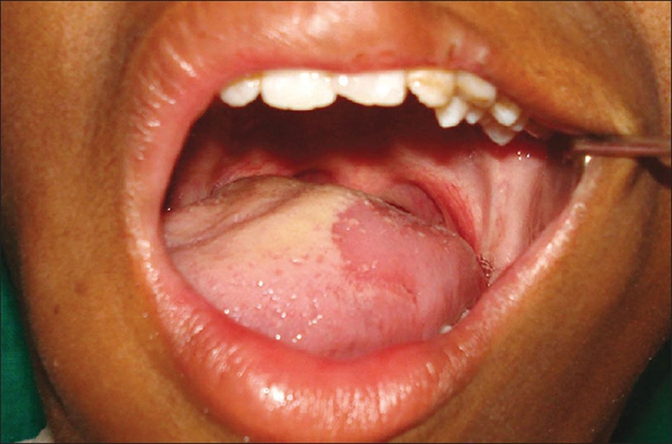 舌炎的症状图片舌图片