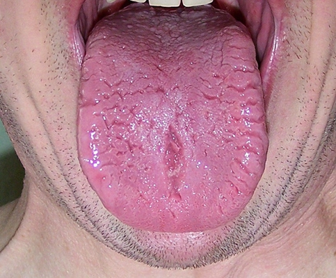 舌炎的症状图片 (10)
