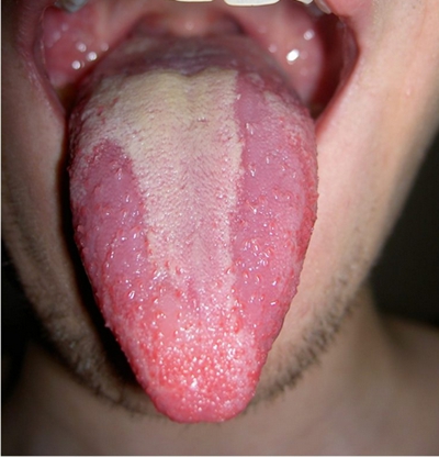 舌炎的症状图片 (38)