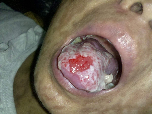 舌炎的症状图片 (49)
