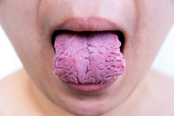 舌炎的症状图片 (6)