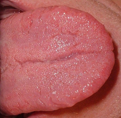 舌炎的症状图片 (9)
