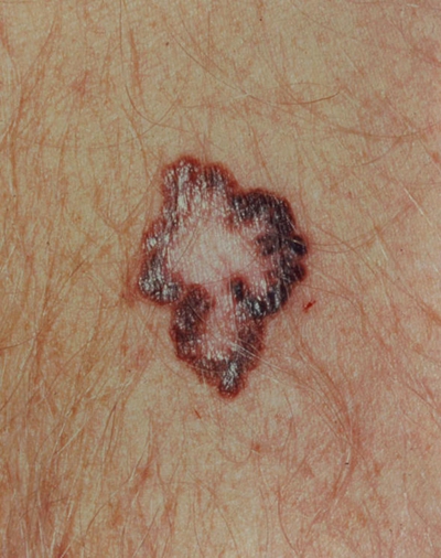 浅表性皮肤癌图片