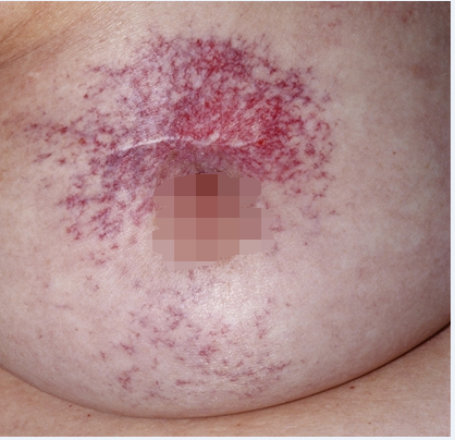 女性胸前湿疹图片