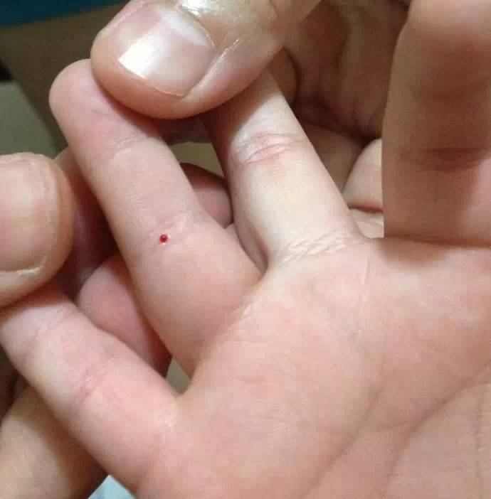 孩子厌食消瘦可以试试针刺四缝穴疗法