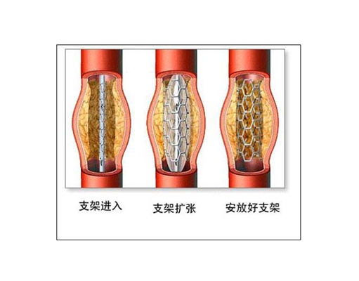 心脏支架手术 (21)