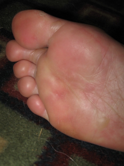 足部疱疹的症状图片图片