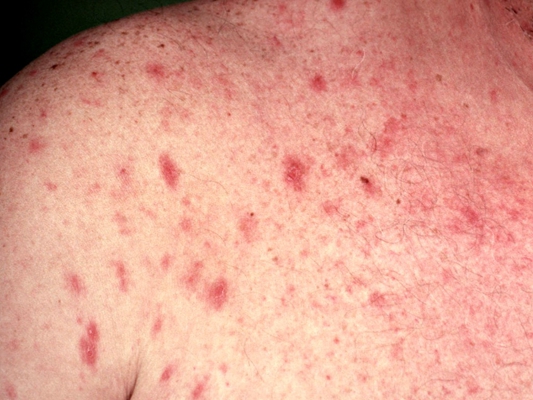 hiv红疹图片 前期图片