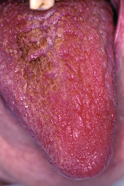 舌炎的症状图片 (14)