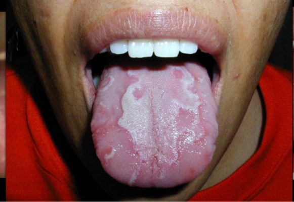 舌炎的症状图片 (17)