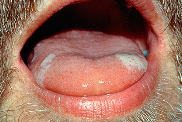 舌乳头炎 患者图片