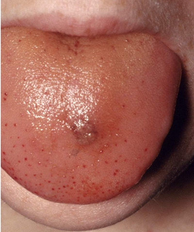 舌头叶状乳头炎症状图片