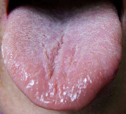 舌炎图片 早期图片