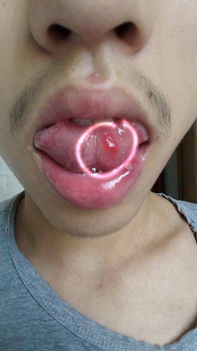 舌乳头炎照片图片