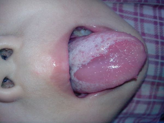 舌炎的症状图片 (7)