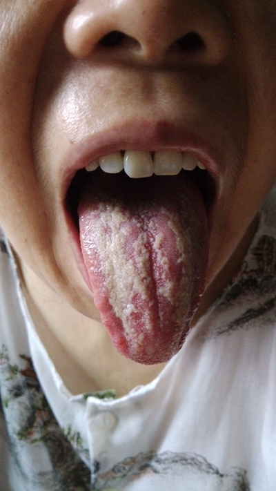 舌炎的症状图片 (5)