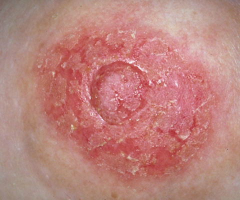 乳房湿疹的症状的照片图片