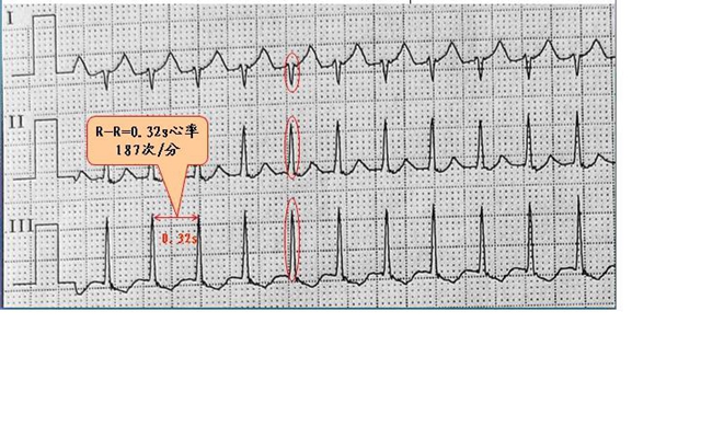 心电图异常 (9)