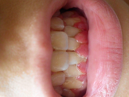 牙龈口腔溃疡根部图片