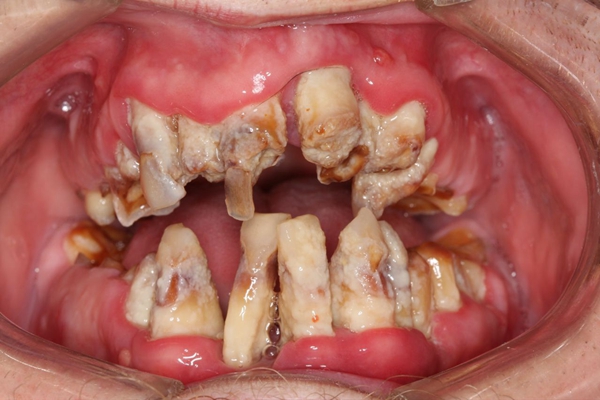 牙菌斑牙齿图片33
