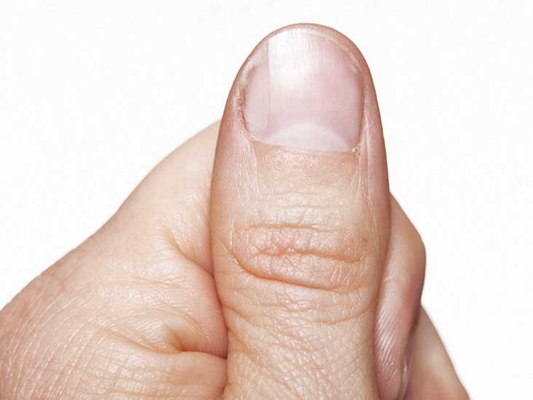大拇指指甲上有竖纹 (4)