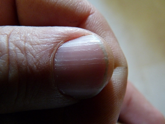 大拇指指甲上有竖纹 (8)
