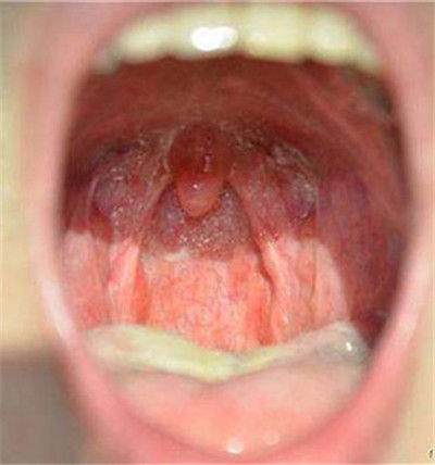 咽炎与正常的咽喉图片图片