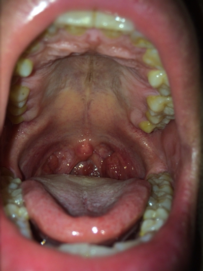 淋巴滤泡咽喉炎图图片图片