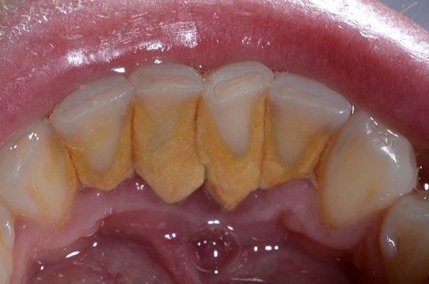 严重牙菌斑图片图片