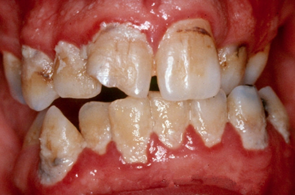 牙齿细菌放大图片图片
