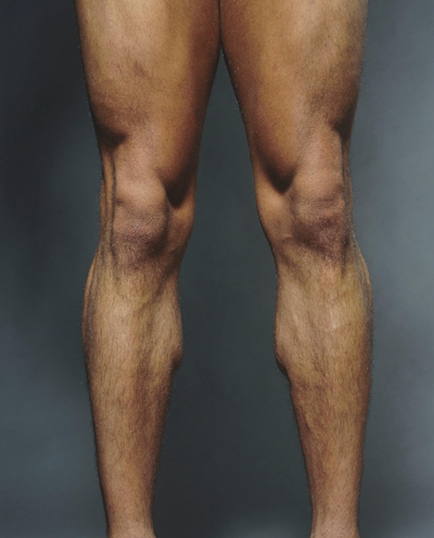 膝盖骨质增生 (32)