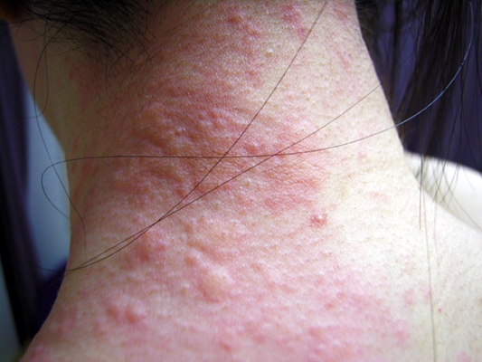 荨麻疹疹子的症状图片图片