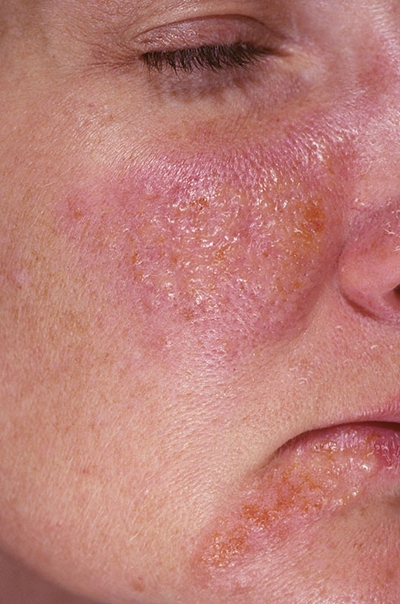 面部湿疹初期图片