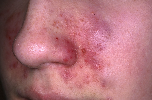 面部湿疹初期图片