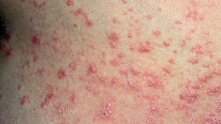 慢性荨麻疹照片图片
