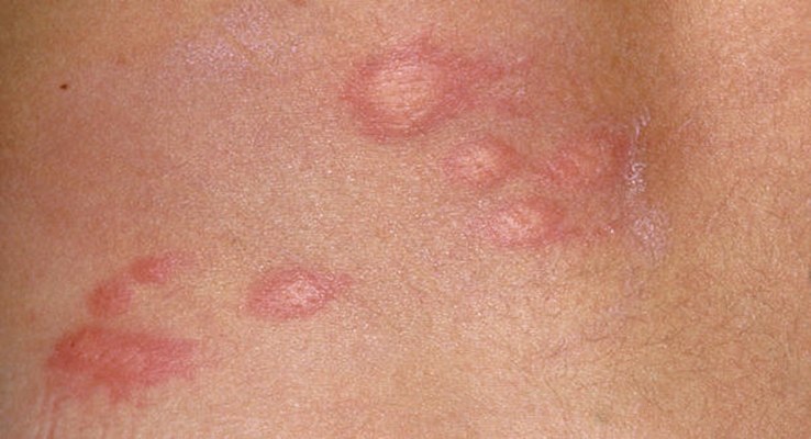 荨麻疹类型对照图初期图片