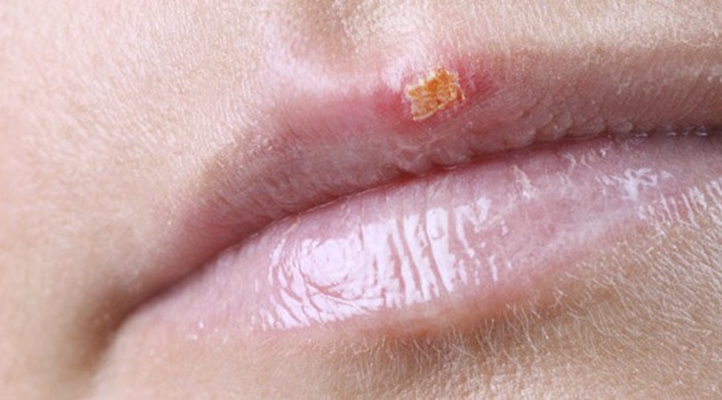 唇膜炎是什么症状图片图片