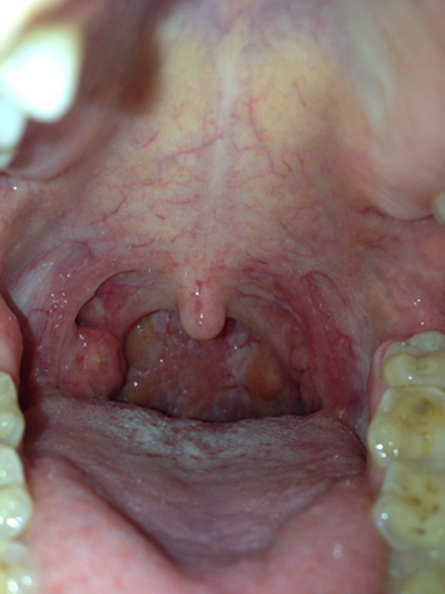 咽喉炎图片和正常图片图片