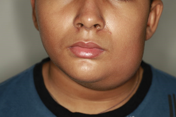 腮腺炎前兆和症状图片图片