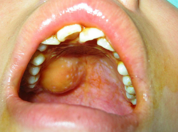 小孩牙龈癌的症状图片图片