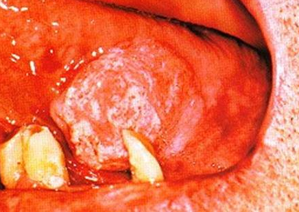 菜花状牙龈癌图图片