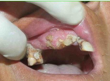 牙龈癌图片 症状早期图片