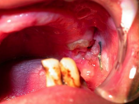 牙癌图片 晚期图片